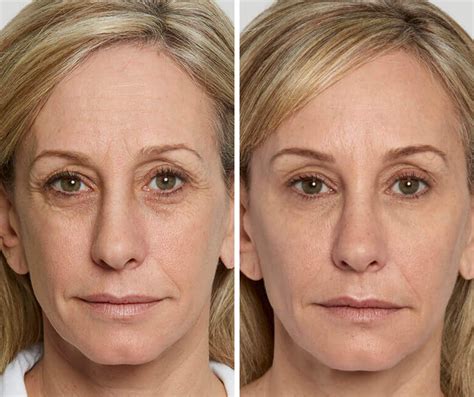 Take 10 Years Off Your Face With Sculptra | The Skin Clinic Scottsdale