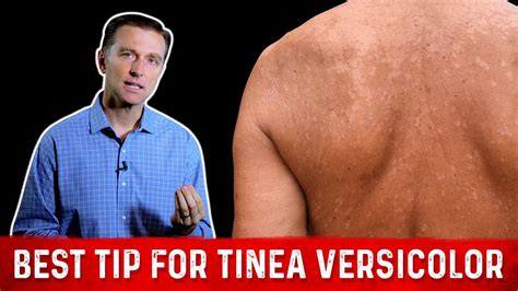 Natural (Skin Fungus) Tinea Versicolor Home Remedies – Dr. Berg - Safer ...