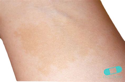 Online Dermatology - Hyperpigmentation : Causes, Types and Treatments