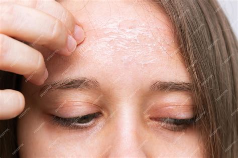 Premium Photo | Female forehead with peeling skin Allergies eczema psoriasis lack of vitamins ...