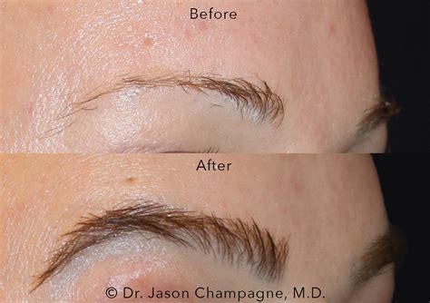 Eyebrow Hair Transplantation Gallery | Beverly Hills Plastic Surgeon - Dr. Jason Champagne