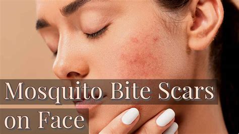 Mosquito bite scars on face: How To Treat Mosquito Bite Marks on the face? - Basic of Science