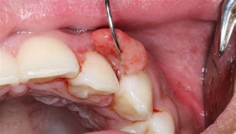 Oral Cancer vs Mouth Ulcer: What is The Difference? - Dezy