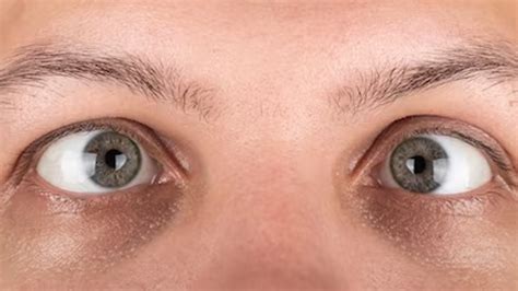 Struggling With Strabismus? Check Out For Its Symptoms, Prevention, And Treatment | OnlyMyHealth