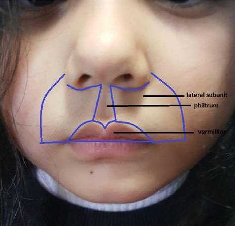 Figure 1 from The Shape of Philtrum Column in Jordanian Population for ...