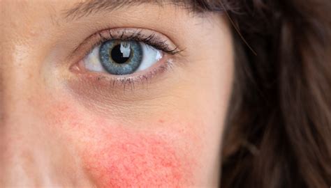 Do you have these 9 symptoms of rosacea? | Guides