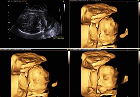 Benefits Of A 4D Ultrasound | PHMC Blog