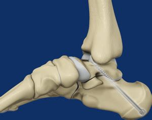 Subtalar arthrodesis Baltimore, MD | Subtalar Fusion | Ankle Doctor Towson