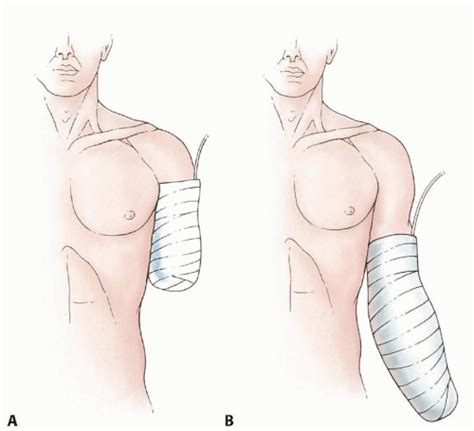 Above-Elbow and Below-Elbow Amputations | Musculoskeletal Key