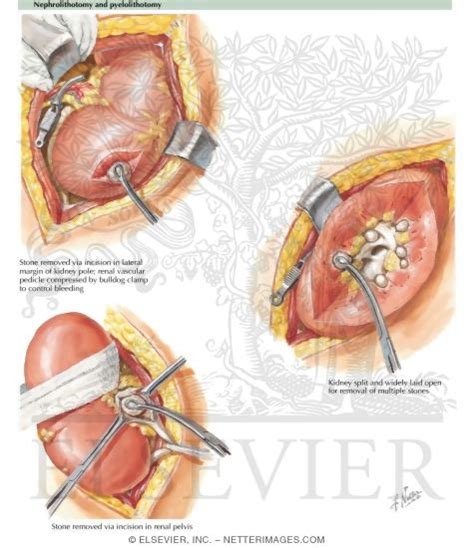 Nephrolithotomy and Pyelolithotomy