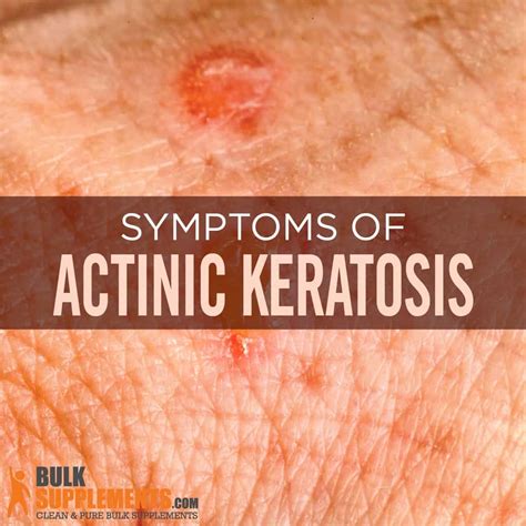 Skin Cancer Actinic Keratosis Hand