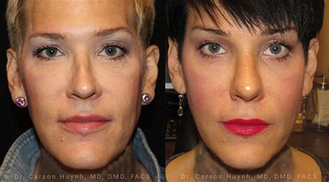 V Line Jawline Surgery in Atlanta & NYC | Radiance Surgery and Aesthetic Medicine