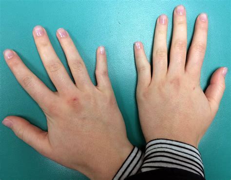 Unusual Clinodactyly | Congenital Hand and Arm Differences | Washington ...