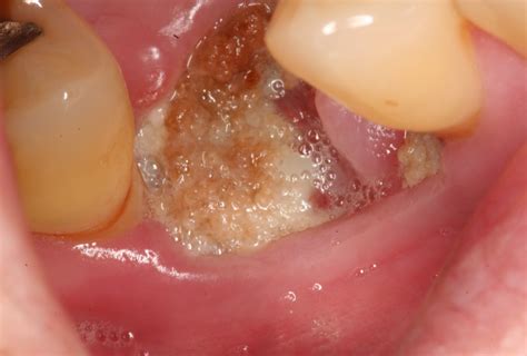 MRONJ: Medication-related osteonecrosis of the jaw management ...