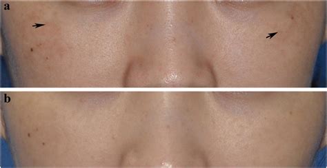 Clinical pictures of a subject with Hori’s nevus with light-brown ...