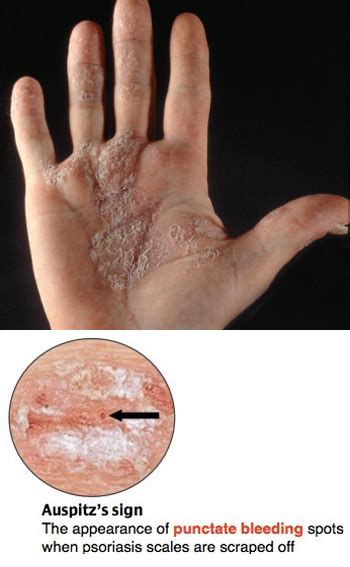 Auspitz Sign Seen In Which Psoriasis : The auspitz sign refers to the ...