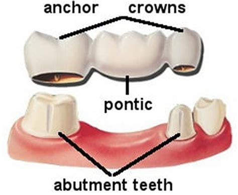 Dental Bridge - Procedure, Dental Bridge Vs Dental Implant