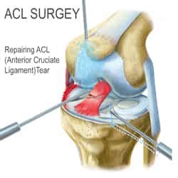 Surgery for a Torn ACL