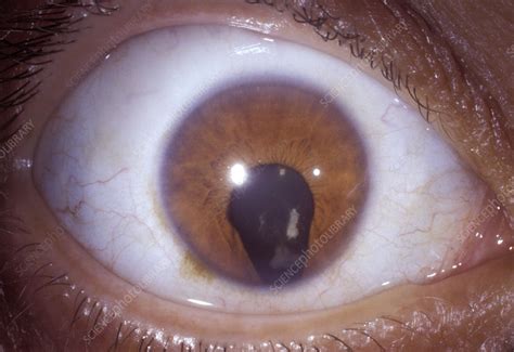 Coloboma of the eye - Stock Image - C054/6314 - Science Photo Library