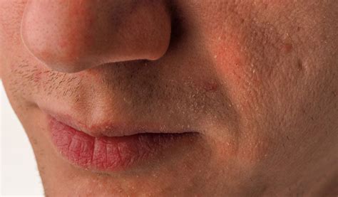 Dry Face Skin - Beauty & Health