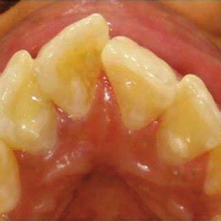 (PDF) Bilateral Talon Cusp-An unusual presentation and its management