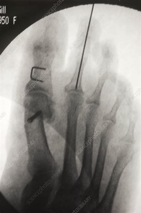 Bunion treatment, X-ray - Stock Image - M120/0206 - Science Photo Library