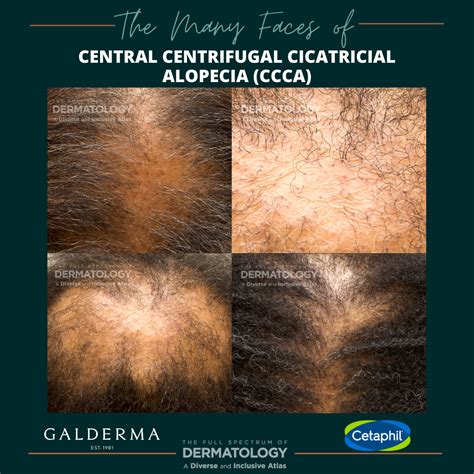 The Many Faces of Central Centrifugal Cicatricial Alopecia (CCCA) - Next Steps in Dermatology