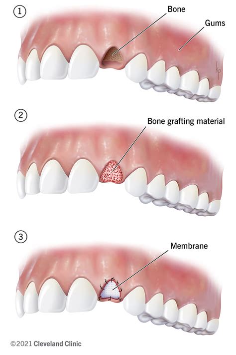 Dental Bone Graft: Process, Purpose & Healing