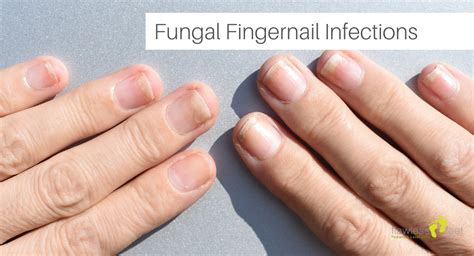 Fungal Fingernail Infections