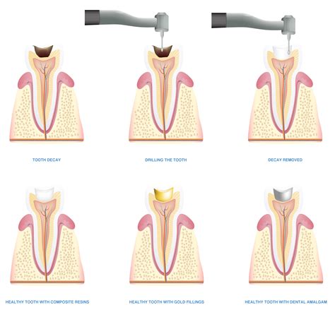 How Do Cavity Fillings Work? - Willow Pass Dental Care