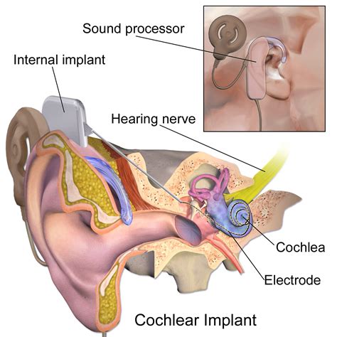 Cochlear Implant Surgery - MPENTA