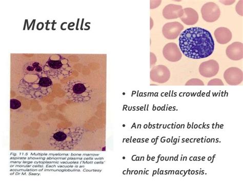 Plasma Cell Disorders