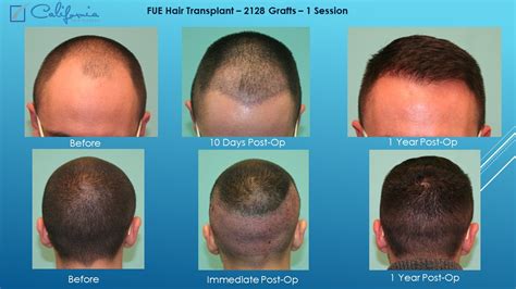 35+ Fue Hair Transplant Recovery Timeline - FergusAshley