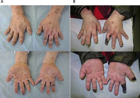 Finger necrosis with eosinophilia and symmetrical occlusion of the peripheral artery | Heart Asia