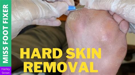 Hard skin removal | [left-foot] | Miss Foot Fixer - YouTube