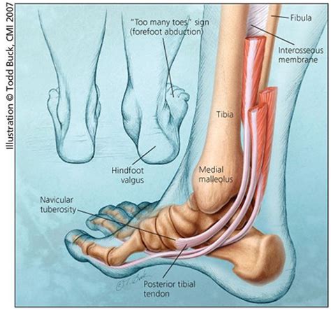 Posterior Tibial Tendon Insufficiency (Adult Acquired Flatfoot): An ...