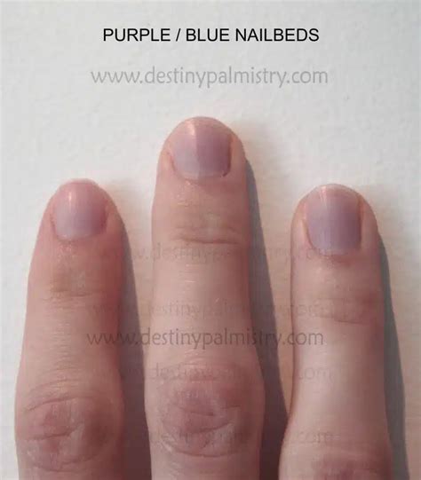 What Causes My Fingernails To Turn Purple - Design Talk