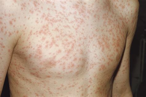 Rubella Rash Images