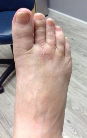 Encino Hallux Varus Correction Before and After Photos - Los Angeles ...