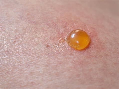 Insect Bite on Skin with Blister. Stock Photo - Image of dermatology ...