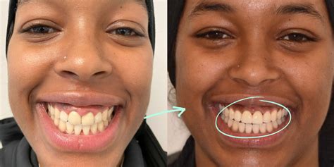 Smile Shape Surgery