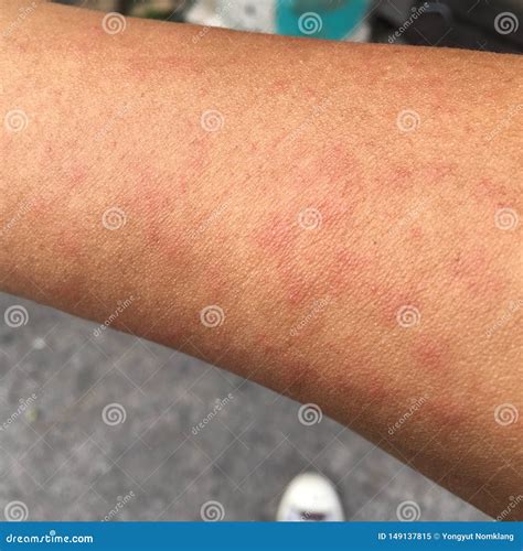 Allergic Rashes On The Arm Stock Photo | CartoonDealer.com #154560138