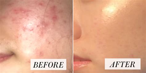 Woman's Skin-Care Routine for Acne Goes Viral - Before and After Photos ...