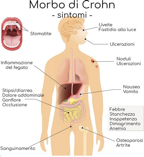 Morbo di Crohn: sintomi, cause, cura e pericoli - Valori Normali