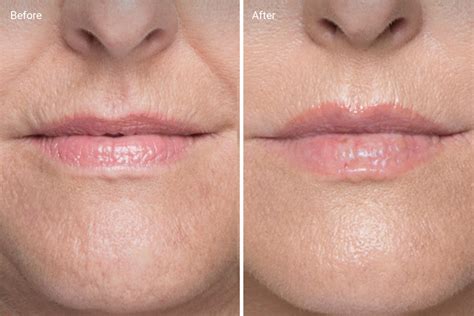 Lip Fillers: How Long They Last, Before & Afters, Side Effects, Cost