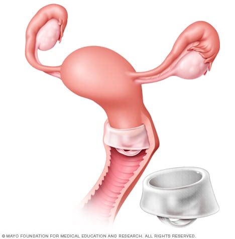 Insertion of a cervical cap - Mayo Clinic