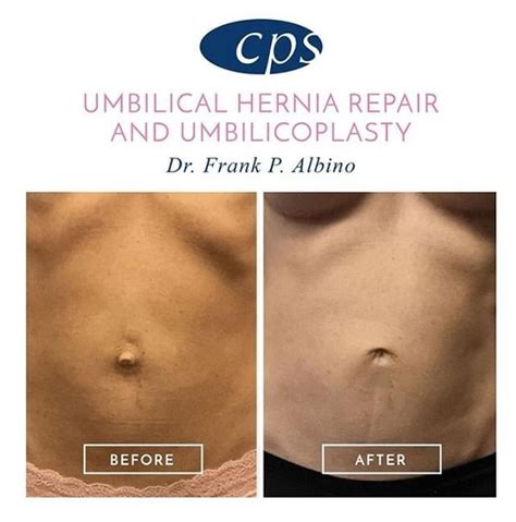 Recovery Time For Laparoscopic Umbilical Hernia Surgery - Printable Templates Free