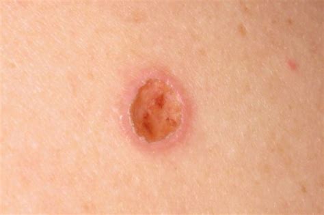 Surviving skin cancer | Article | The United States Army