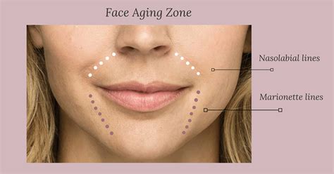 How Do Nasolabial Lines Form, and What Can We Do to Fight Them?