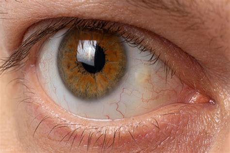 Pinguecula (Yellow Bump on Eyeball): Diagnosis, Causes & Treatment ...